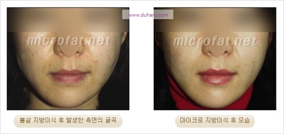 [두한성형외과 경쟁력 지방이식] - [두한 자가지방이식 클리닉 안내]​ 관련 이미지 78