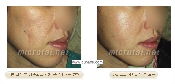 [두한성형외과 경쟁력 미세지방이식] - [미세지방이식 부작용 종류와 교정방법 안내] 관련 이미지 7