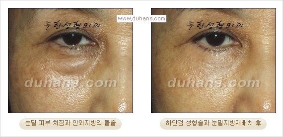[두한성형외과 경쟁력 다크써클 교정] - [젊어 보이면서 개선된 인상을 주는 하안검 성형술] 관련 이미지 11