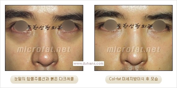 [두한성형외과 경쟁력 눈밑성형] - [눈밑 미세지방이식으로 다크써클 치료] 관련 이미지 15