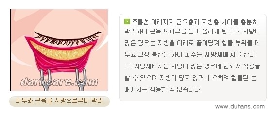 ​[두한성형외과 NO.1 다크써클 교정] - [하안검 성형술 + 눈밑지방 재배치] 관련 이미지 6