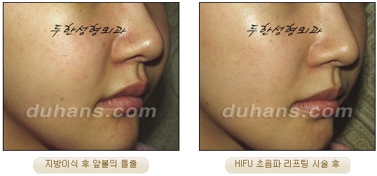 [Duhan Plastic Surgery Lift] - [Double Chin, Drooping Cheeks, Sagging Neck Skin, Wrinkle Improvement] image 17