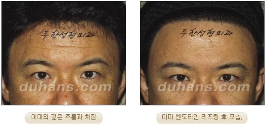 두한성형외과 안티에이징 리프팅 - 엔도타인 리프팅 관련 이미지 29