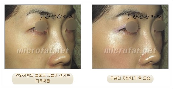 [두한성형외과 쌍커풀수술] - [눈성형 방법에 대한 자주하는 질문과 답변] 관련 이미지 161