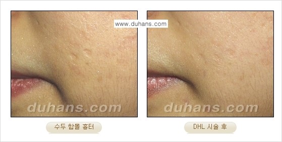 [두한성형외과 함몰 흉터 교정] - [동시에 3가지 시술로 효과적인 흉터의 교정 안내 ②] 관련 이미지 5