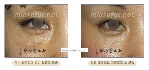 [두한성형외과 경쟁력 미세지방흡입] - [안면부의 안전한 미세지방흡입 안내] 관련 이미지 15