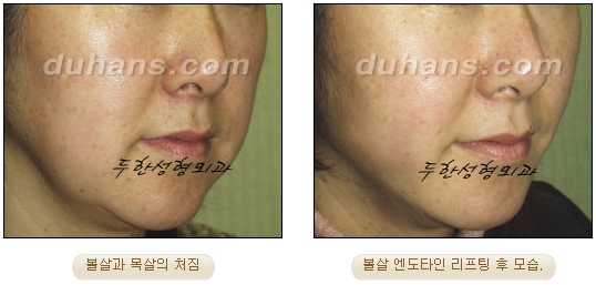[Duhan Plastic Surgery Wrinkle Removal] - [Wrinkle Removal Treatment Methods] image 28