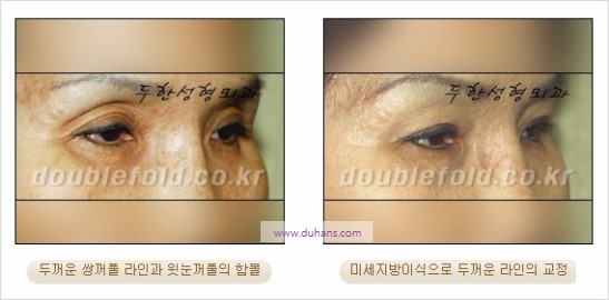 [두한성형외과 경쟁력 눈성형] - [쌍꺼풀 재수술에 대한 최선의 대안 제시] 관련 이미지 19