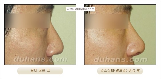 [두한성형외과 경쟁력 코성형] - [실리콘, 알로덤, 미세지방이식을 이용한 맞춤 코성형] 관련 이미지 15