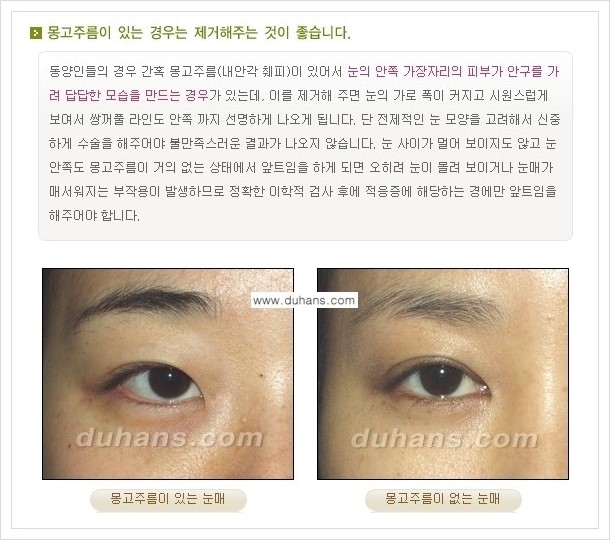 [두한성형외과 경쟁력 눈성형] - [아름답고 자연스러운 눈매, 매력적인 쌍꺼풀 안내] 관련 이미지 5