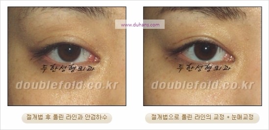 [두한성형외과 경쟁력 쌍꺼풀 재수술] - [풀린 라인 교정(Correction released fold line) 방법] 관련 이미지 2