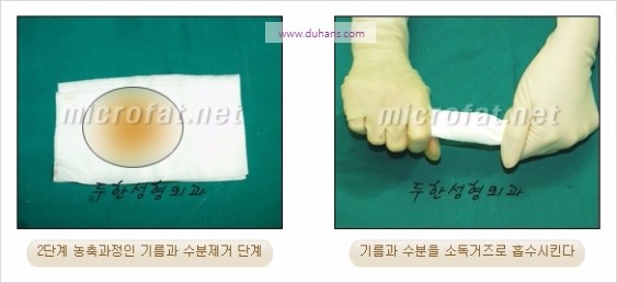 [두한성형외과 경쟁력 윤곽성형] - [볼, 볼살 지방이식] 관련 이미지 9
