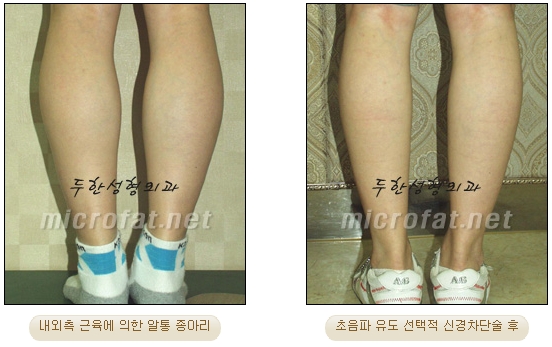 [Duhan Plastic Surgery Clinic Calf Contouring] - [Calf Reduction] image 23
