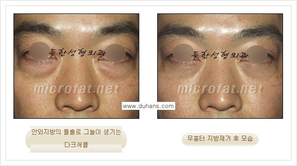 [두한성형외과 경쟁력 눈밑성형] - [눈밑지방제거, 눈위지방제거 안내 2.] 관련 이미지 3