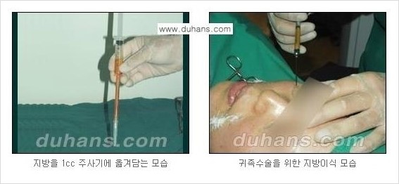 [두한성형외과 경쟁력 입체지방이식] - [인디언밴드, 앞광대주름 미세지방이식] 관련 이미지 6