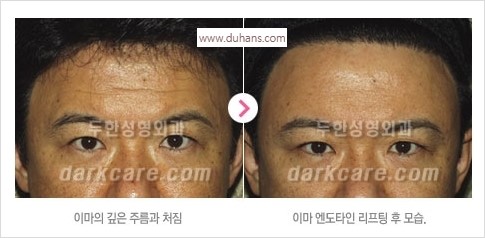 [두한성형외과 경쟁력 주름성형] - [주름제거와 볼륨을 갖게하는 엔도타인 리프팅] 관련 이미지 25