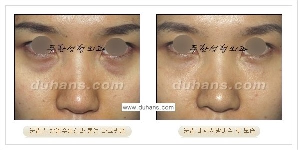 [두한성형외과 경쟁력 눈밑성형] - [꺼진 눈밑, 눈밑 함몰 주름선 눈밑 미세지방이식 안내] 관련 이미지 31