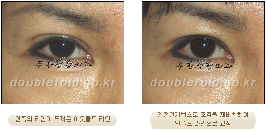 두한성형외과 쌍커풀 재수술 - 눈매교정 재수술 관련 이미지 66