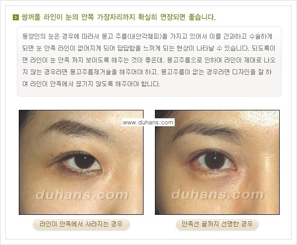 [두한성형외과 경쟁력 눈성형] - [아름답고 자연스러운 눈매, 매력적인 쌍꺼풀 안내] 관련 이미지 2