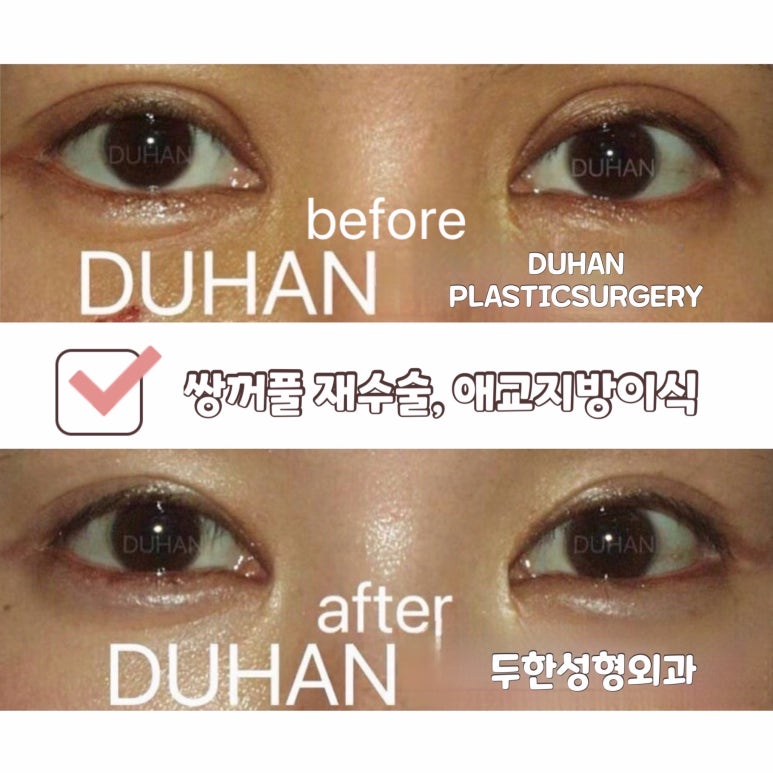 Double Eyelid Line Correction + Volume for Tear Troughs to Change the Impression image 1