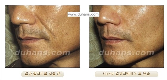 [두한성형외과 경쟁력 미세지방이식] - [탄력있는 피부와 윤곽을 만들어주는 Col-fat 지방이식] 관련 이미지 13