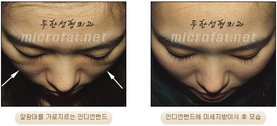 [Duhan Plastic Surgery Face Autologous Fat Grafting] - [Noble Surgery and Indian Band Fat Grafting] image 25
