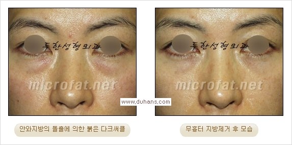 [두한성형외과 경쟁력 눈밑성형] - [과도한 눈밑지방제거의 부작용 후 눈밑지방재배치] 관련 이미지 12