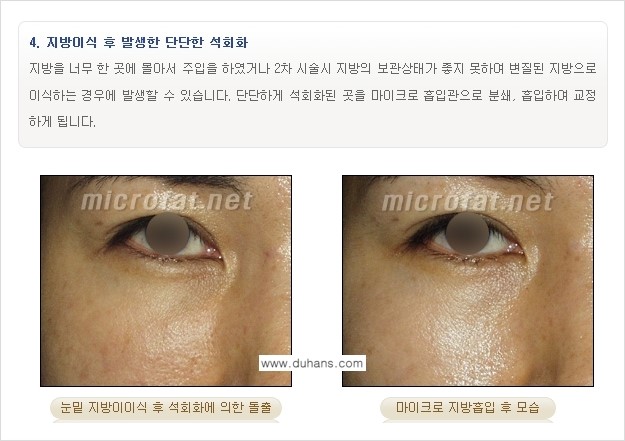 [두한성형외과 "미세지방이식"] - [지방이식 부작용 교정 정보 ③] 관련 이미지 4