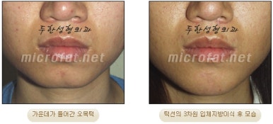 [Duhan Plastic Surgery Clinic Microgenia Correction] - [Chin Microfat Grafting] image 13