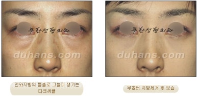 [두한성형외과 지방제거] - [눈두덩이지방제거, 눈밑지방제거] 관련 이미지 47