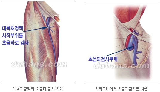 [두한성형외과 정맥류] - [하지정맥류, 정맥확장증, 혈관확장증] 관련 이미지 6