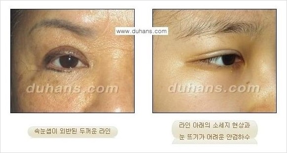 [두한성형외과 경쟁력 쌍꺼풀 재수술, 극한 눈재수술] - [쌍꺼풀 재수술, 눈재수술 실패의 원인 안내] 관련 이미지 1