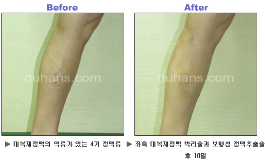 [두한성형외과 정맥류] - [하지정맥류, 정맥확장증, 혈관확장증] 관련 이미지 33