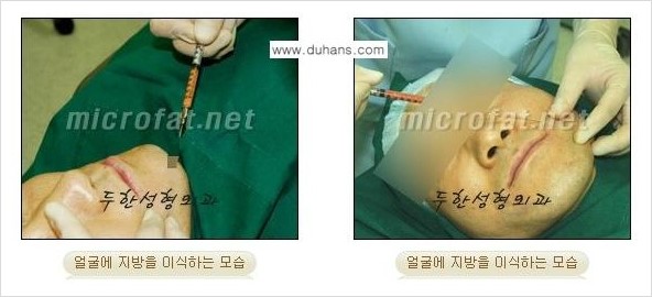 ​[두한성형외과 경쟁력 지방이식] - [지방이식 부작용 이후 마이크로 지방흡입, 마이크로 지방흡입 이후 부작용 없는 지방이식 방법] 관련 이미지 16