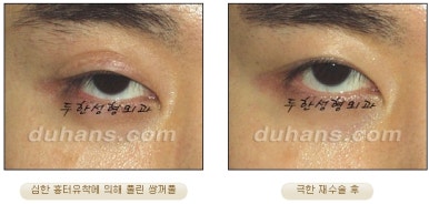 [Special Double Eyelid Revision Surgery at Duhan Plastic Surgery] - [Restorative Surgery for Damaged Double Eyelid Eye Shape] image 28