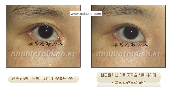 [두한성형외과] - [아웃폴드를 인폴드로 변화시키는 쌍꺼풀재수술] 관련 이미지 3