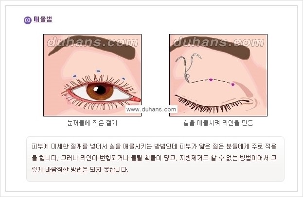 [두한성형외과 경쟁력 눈성형] - [아름답고 자연스러운 눈매를 위한 퀵쌍꺼풀 안내] 관련 이미지 8