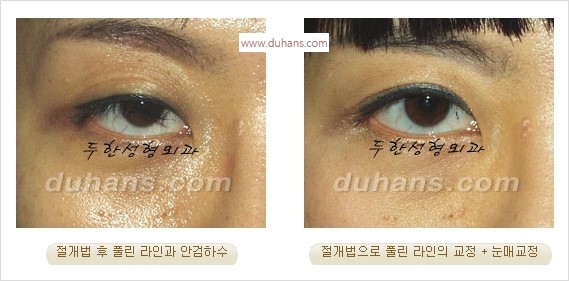 [두한성형외과 경쟁력 눈성형] - [풀려버린 쌍꺼풀 교정 방법] 관련 이미지 5
