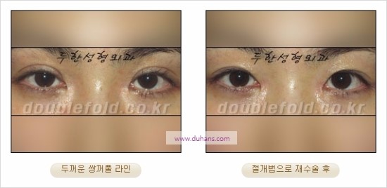 [두한성형외과 경쟁력 눈성형] - [쌍꺼풀 재수술에 대한 최선의 대안 제시] 관련 이미지 11