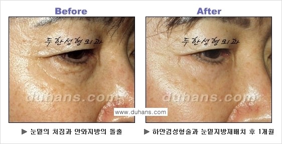 [두한성형외과의 상큼하고 환한 젊은 눈매완성] - [하안검 성형술 ①] 관련 이미지 12