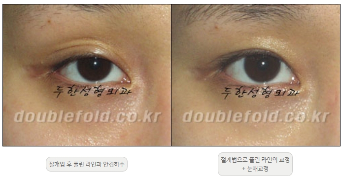 [두한성형외과 쌍커풀재수술] - [풀린 쌍커풀라인 교정] 관련 이미지 8