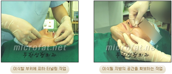 Fat Grafting Leader Duhan Plastic Surgery - Everything About Fat Grafting image 61