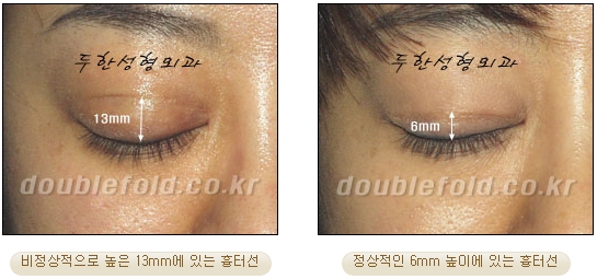 Best Place for Revision Eyelid Surgery, Duhan Plastic Surgery - Lowering Double Eyelid Line image 30