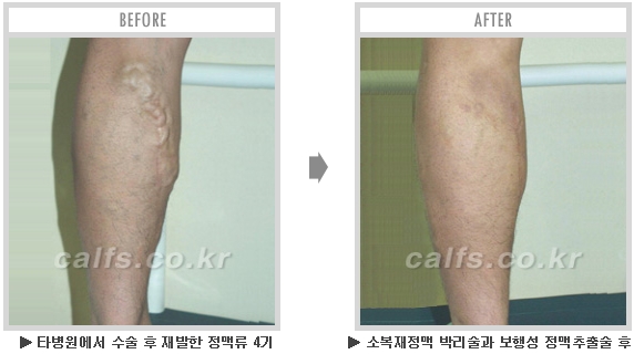 [종아리성형 두한성형외과] - [종아리수술에 대한 자주하는 질문과 답변 모음] 관련 이미지 19