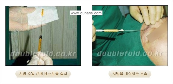 [두한성형외과 NO.1 눈성형] - [함몰된(꺼진) 눈꺼풀에서 쌍꺼풀 라인 교정 2.] 관련 이미지 3