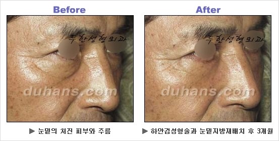 [두한성형외과 경쟁력 동안성형 리더] - ​[미간주름, 이마주름, 안검성형, 이마거상술, 눈썹거상술] 관련 이미지 97