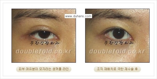[두한성형외과 경쟁력 쌍꺼풀 재수술] - [피부 여유분이 부족해서 토안증이 발생한 경우 극한 재수술] 관련 이미지 1