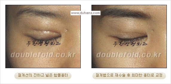 [두한성형외과 경쟁력 쌍꺼풀 재수술, 극한 재수술] - [쌍꺼풀 재수술에서 극복해야 할 극한의 상황과 문제들] 관련 이미지 4