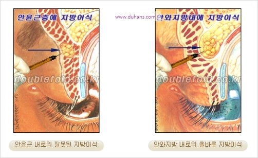 [두한성형외과 경쟁력 눈성형] - [극한 재수술, 함몰된 눈꺼풀 라인교정, 안검하수(졸리운 눈매)] 관련 이미지 38
