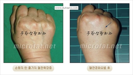 [두한성형외과 경쟁력 정맥류 치료] - [손, 손등, 손목혈관확장증, 팔혈관확장증에 질문과 답변] 관련 이미지 10
